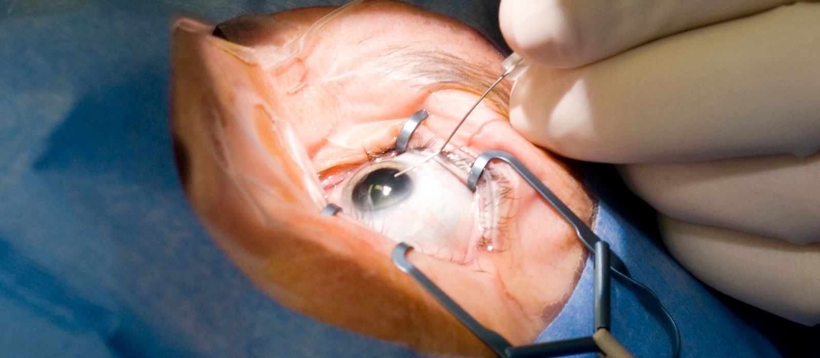 Recuperação da Cirurgia de Catarata: Quanto Tempo Demora e Quais Cuidados São Necessários?